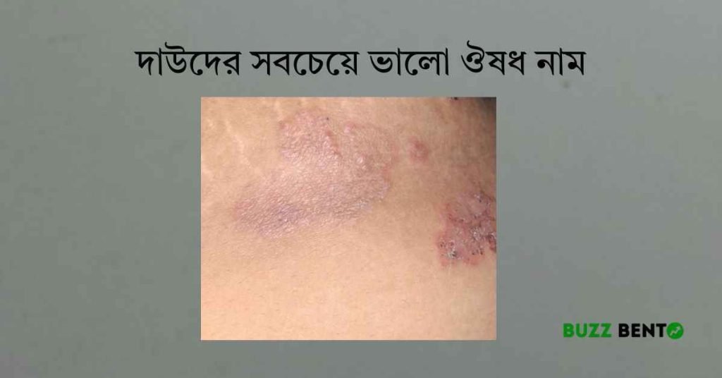 দাউদের সবচেয়ে ভালো ঔষধ নাম কি? দ্রুত নিরাময়ের কার্যকরী উপায়