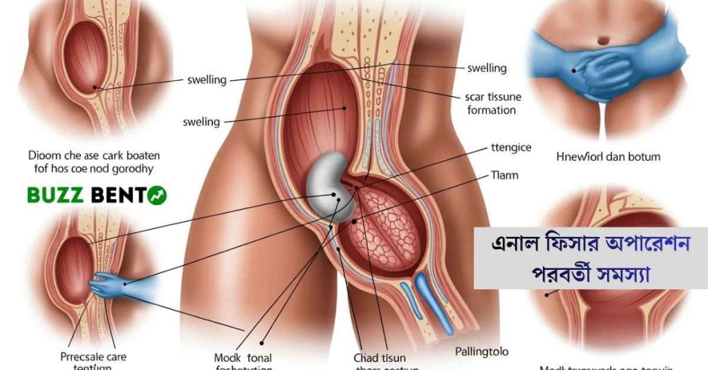 এনাল ফিসার অপারেশন পরবর্তী সমস্যা
